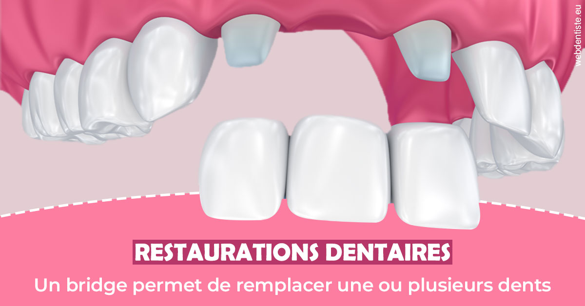 https://www.drlaparra.fr/Bridge remplacer dents 2
