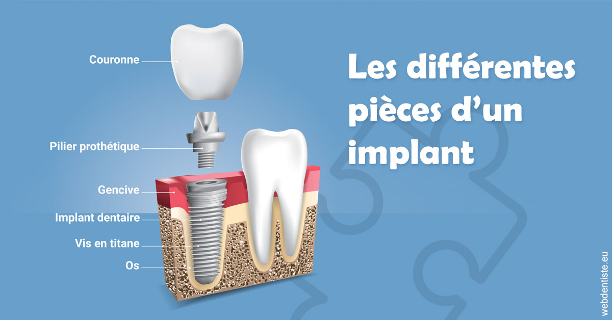 https://www.drlaparra.fr/Les différentes pièces d’un implant 1