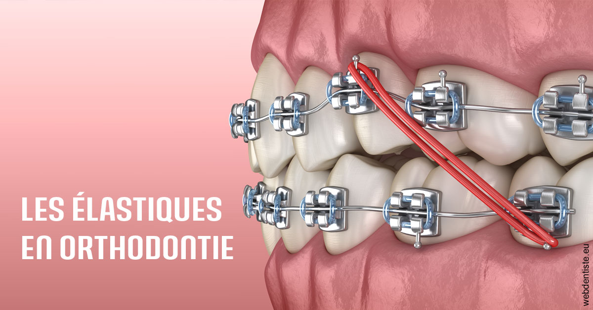 https://www.drlaparra.fr/Elastiques orthodontie 2